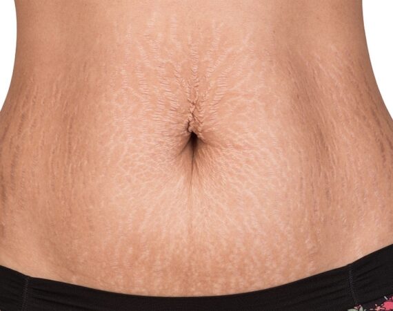 Women body with fat belly and stretch marks