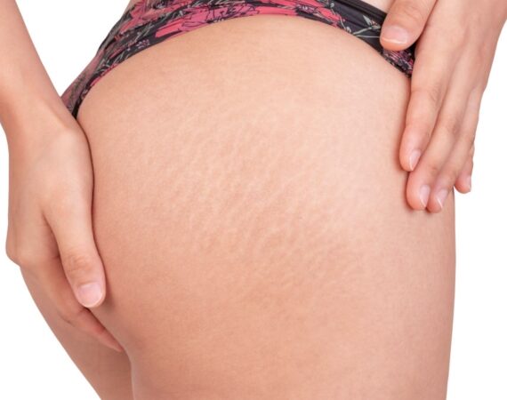 Female hips with a stretch marks and cellulite.